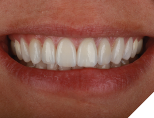 Post-op photos of a very pleased patient