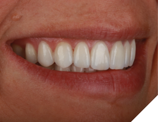 Post-op photos of a very pleased patient