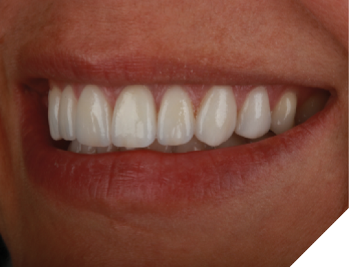Post-op photos of a very pleased patient