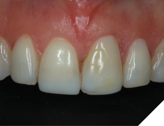 The patient was displeased with the shade of the anterior composite veneers as well as the appearance of a black triangle between teeth #8 ad #9. 