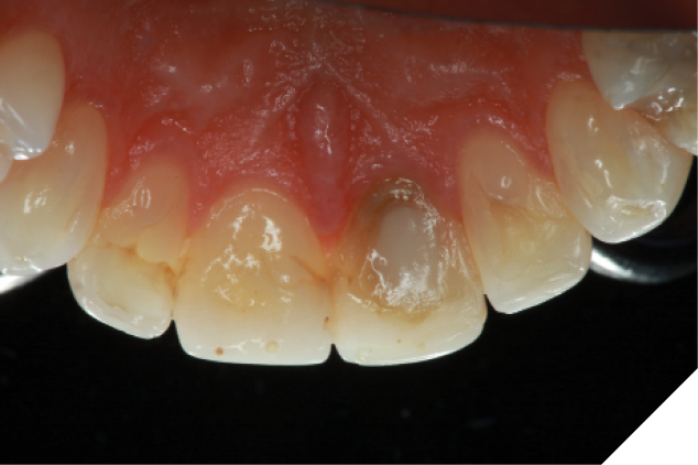  Initial examination and x-rays revealed the root canal therapy with lingual composite filling.