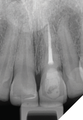  Initial examination and x-rays revealed the root canal therapy with lingual composite filling.
