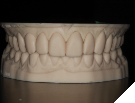  A 3D printed wax prototype of the proposed final outcome created by the laboratory maintained the natural shape of the patient’s teeth but added length and symmetry to enhance her smile.