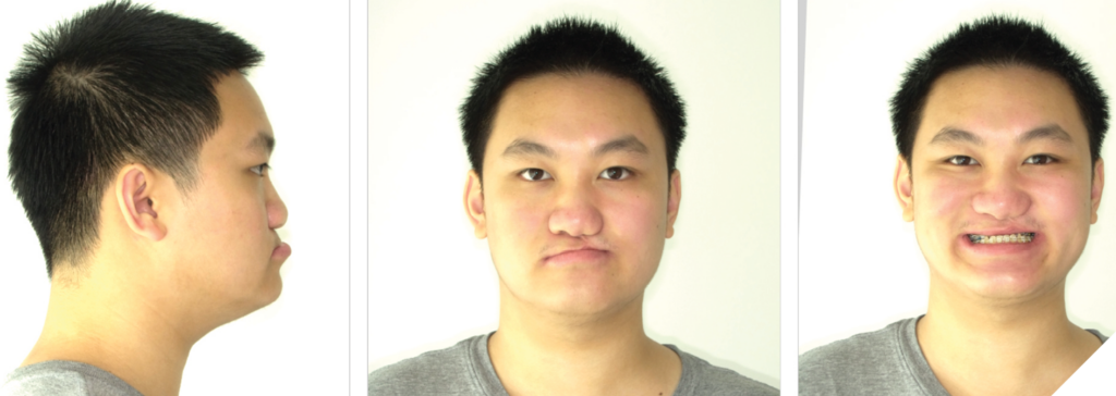 Clinical photographs of the patient’s profile, frontal, and frontal smiling views.