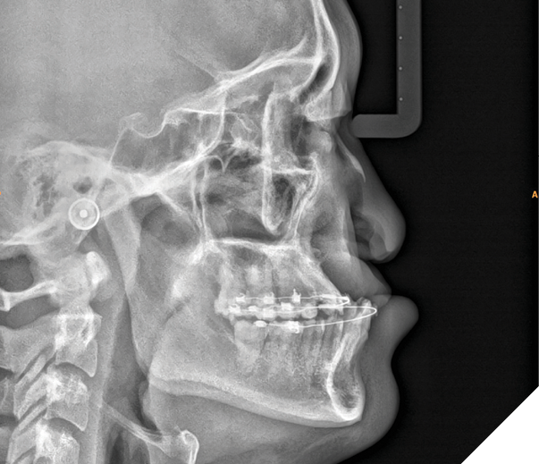 Lateral Ceph showing his significant maxillary hypoplasia and class III skeletal relationship.