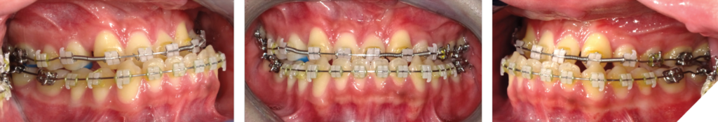 Intra-oral clinical photographs