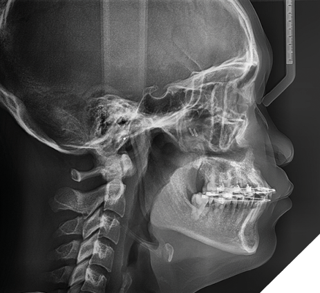 Final lateral cephalogram after distractor removal.