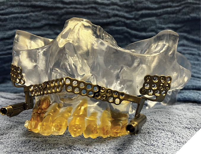 3D-printed stereolithographic crystal skull model included with the virtual planning service. KLS Martin Hyperdrive (Jacksonville, USA) distractors have been adapted and fixated.