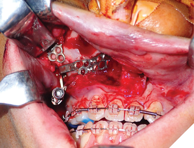 Intra-operative photographs showing adaptation of the distractors to the maxilla, and 701 bur markings between the foot plates to indicate the ideal level for the Lefort 1 osteotomy.