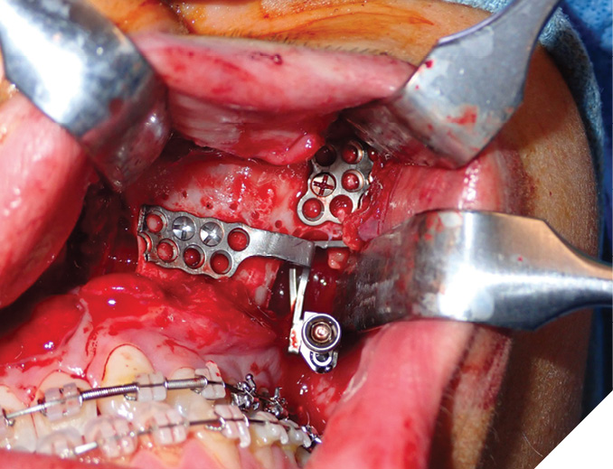 Intra-operative photographs showing adaptation of the distractors to the maxilla, and 701 bur markings between the foot plates to indicate the ideal level for the Lefort 1 osteotomy.