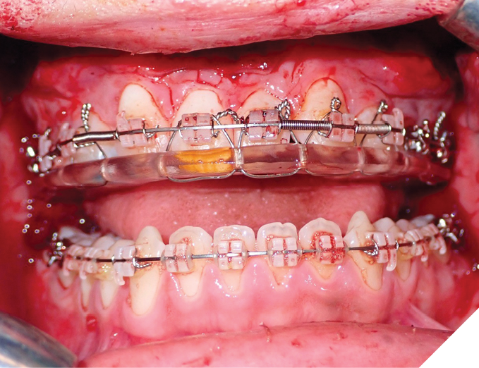 Temporary wiring of an occlusal splint to the maxilla during downfracture and mobilization to prevent fracture along the previously repaired alveolar cleft site.