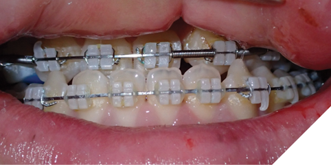 Progressive clinical photographs showing maxillary advancement during distraction, followed by midline correction via asymmetric distraction.