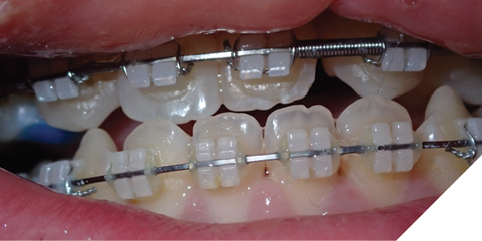 Progressive clinical photographs showing maxillary advancement during distraction, followed by midline correction via asymmetric distraction.