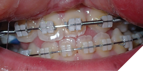 Progressive clinical photographs showing maxillary advancement during distraction, followed by midline correction via asymmetric distraction.