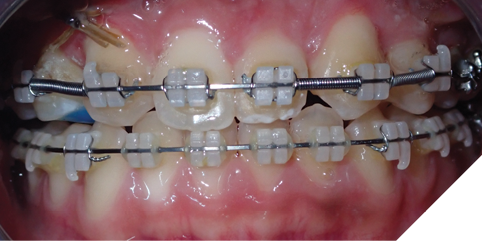Progressive clinical photographs showing maxillary advancement during distraction, followed by midline correction via asymmetric distraction.