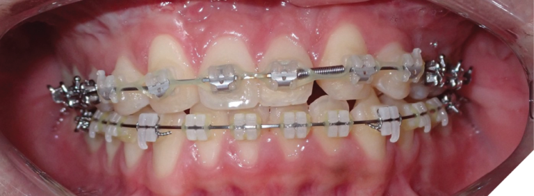 Progressive clinical photographs showing maxillary advancement during distraction, followed by midline correction via asymmetric distraction.