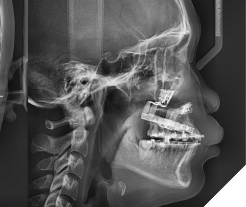 Post-operative lateral cephalogram showing the significant maxillary advancement achieved with distraction, and resolution of the patients class III skeletal and dental relationships.