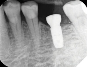 The implant was placed epi-crestally at the left mandibular molar site as a single-stage procedure in August 2019.