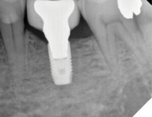 Restoration with a screw-retained crown happened in December 2019.