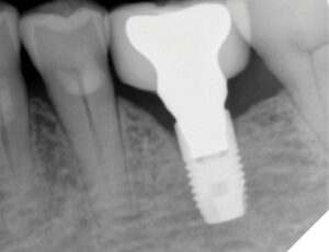 A radiograph taken in July 2021 during a recall exam revealed some crestal bone loss. The patient had presented with a primary complaint of a loose crown.