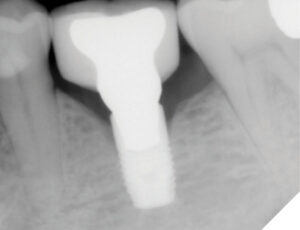 A radiograph taken in September 2022 showed further crestal bone loss particularly on the distal aspect.