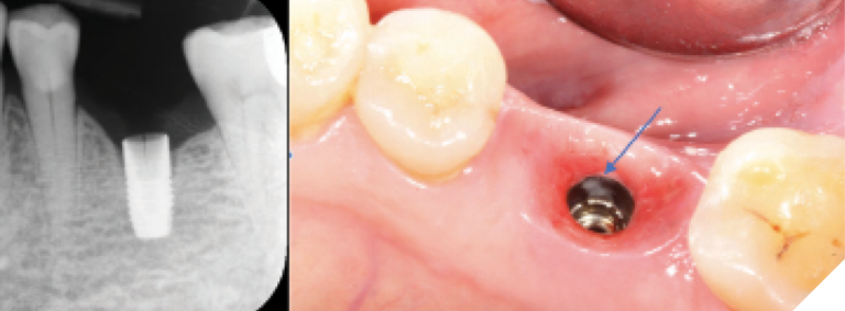 A periapical radiographclinical photo taken after removing the crown in October 2022 clearly showed a fracture on the buccal wall of the internal connection.