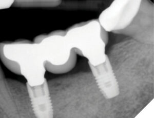 At 14 months post-restoration there was noticeable bone loss mesial to the distal implant.