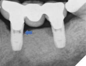 The patient returned in January 2023 after her dentist noted further vertical bone loss at both implants although the early crack (arrow) on the distal aspect of the mesial implant was not noted at the time.