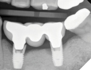 The patient presented in May 2023 complaining of a loose prosthesis; radiographic and clinical examination revealed a fractured implant.