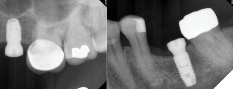 3A. A 6mm Astra implant was placed epi-crestally at the left maxillary second bicuspid site in November 2017; 3B. The mandibular molar implant was 9mm in length and was placed epi-crestally somewhat distally to engage bone maximally.