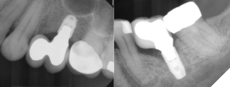 3C. November 2017 - The maxillary prosthesis included a cantilevered left pontic.
3D. November 2017 - At restoration, the molar implant had already suffered some mesial bone loss.