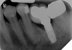 March 2022 - A periapical radiograph of the maxillary implant showed vertical mesial bone loss.
