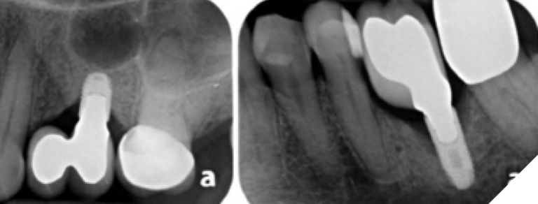 3F. The radiograph of the molar implant, although elongated, showed further bone loss. 3G. A vertical bitewing radiograph taken in December 2022 showed advanced bone loss at both implants and a fine, vertical, mesial fracture of the molar implant.