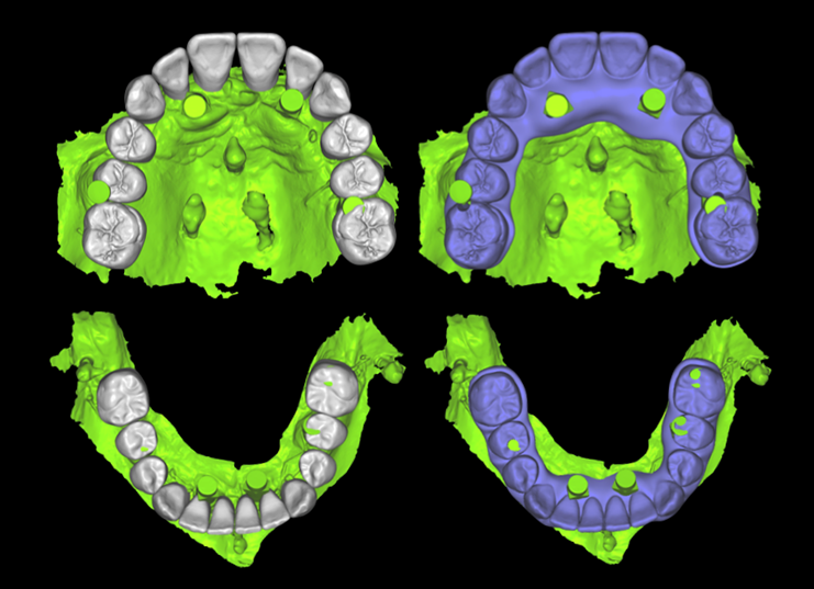 Overlay of original digital wax-up on implant scan for conversion prosthesis fabrication.