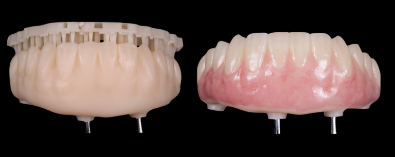 11AB. An example of a 3D printed prosthesis before and after processing