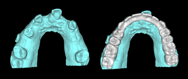2A. Pre-op Maxillary Intraoral Scan.
2B. Pre-op Scan with Digital Wax-up.