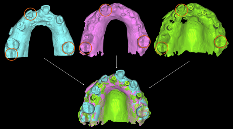 Selective extractions using 3 teeth as common points between the three scans which enables the digital software to merge the files. The implants which have just been placed are now in the same 3D space as the original pre-op scan which had the wax-up.
