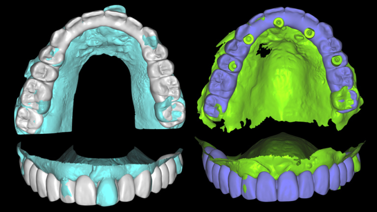 Waxup and preop (shown on the left) can be converted to the prosthesis on the implants (shown on the right).