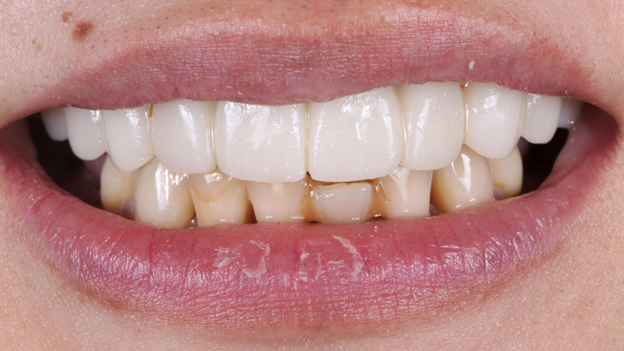 Smile of patient immediately after insertion of conversion prosthesis.