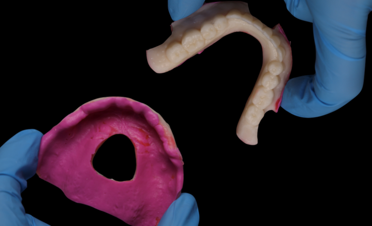 Relined maxillary and mandibular trial prosthesis. The cutouts in the prosthesis are to allow prosthesis to be scanned intraorally with reference points.