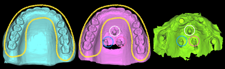 8A. Scanned maxillary trial prosthesis. 8B. Scanned trial prosthesis with 3 TADs in the centre of the palate. 8C. Intraoral scan of the 4 maxillary implants with the 3 TADs in the centre of the palate.
