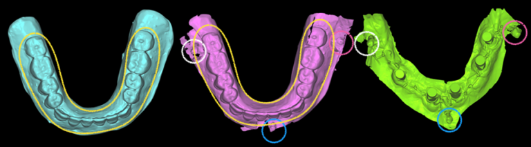 9A. Scanned mandibular trial prosthesis. 9B. Scanned trial prosthesis with 3 TADs (one in the midline, 2 on the buccal shelf). 9C. Intraoral scan of the 5 mandibular implants with the 3 TADs.