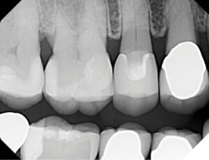 SDF in a restorative dental practice: A prosthodontist’s perspective ...