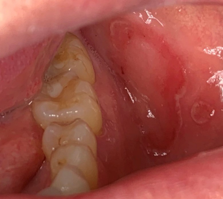 Erosive lichen planus of left buccal mucosa.