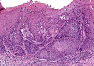 Histopathology, superficial squamous cell carcinoma of tongue (courtesy of Oral and Maxillofacial Pathology, University of Toronto).
