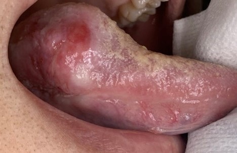 Invasive, moderately differentiated, keratinizing squamous cell carcinoma of tongue, conventional type.