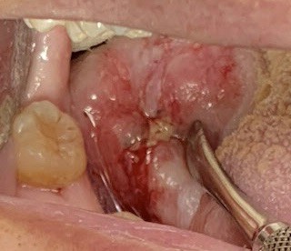 Invasive, moderately differentiated, keratinizing squamous cell carcinoma of tongue, conventional type.