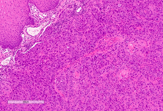 Medium power view shows keratinization and squamous differentiation with pleomorphism and mitoses.
