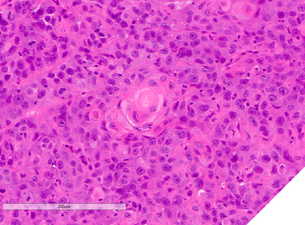 High power view shows keratinization and squamous differentiation with pleomorphism and mitoses.