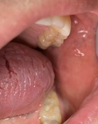 Resolution of lesion with topical fluocinonide.